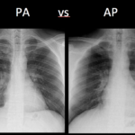 Chest X-Ray Basics: PA vs. AP