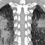 Coronal Chest CT: COVID demonstrating Nodular and Mass-like Airspace Opacities
