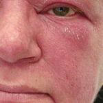 Dermatomyositis