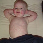 Fifth Disease