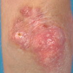 Dermatomyositis