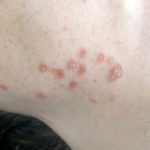 Cutaneous findings in systemic sarcoidosis