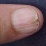Darier’s Disease (ungual findings)