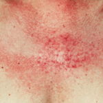 Dermatomyositis