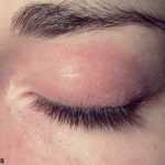 Dermatomyositis