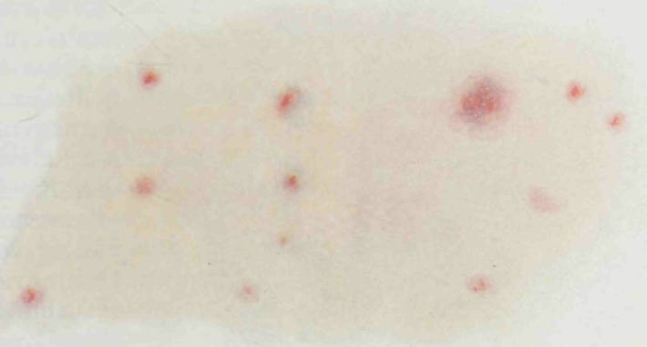 Epidemic_Typhus._Petechial_rash