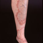 Generalized granuloma annulare