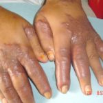 Kaposi’s Sarcoma