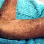 Scleroderma