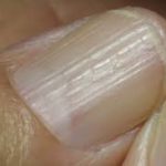 Lichen planus nails