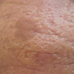 Lipoid Proteinosis (hyalinosis cutis et mucosae or Urbach-Wiethe disease)