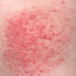 Polymorphic light eruption