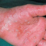 Pompholyx Eczema