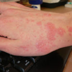 Scabies