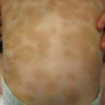 Urticaria Pigmentosa