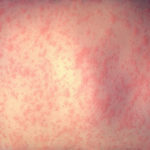Measles morbilliform rash