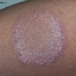 Tinea Corporis