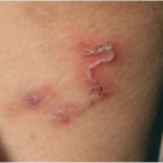 Cutaneous larva migrans