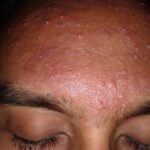 Acne (Facial)