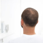 Can Being Bald Put You at a Higher Risk for COVID-19