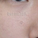 Desmoplastic Trichoepithelioma