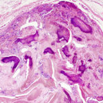 Pilomatricoma/Pilomatrixoma, histopathology