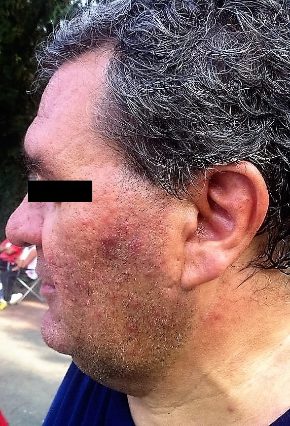 Understanding the Link Between Rosacea and Other Physical and Psychological Conditions