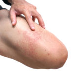 Less than 1 percent of Images on COVID-19 Skin Rash Site are of Black and Brown Patients