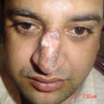 Discoid Lupus Erythematoses