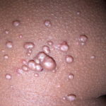 Molluscum contagiosum