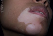 Vitiligo (segmental type)