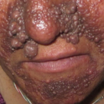 Tuberous Sclerosis